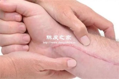做完瘢痕手術(shù)能吃陳皮嗎