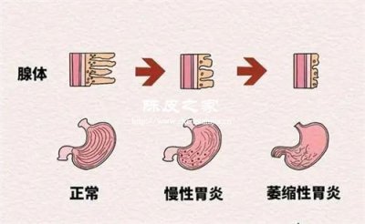 白術(shù)和陳皮泡水喝治療胃炎嗎