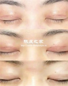 割了雙眼皮可以喝陳皮泡的水嗎