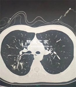 陳皮多糖對PM2.5致肺損傷的防護機制